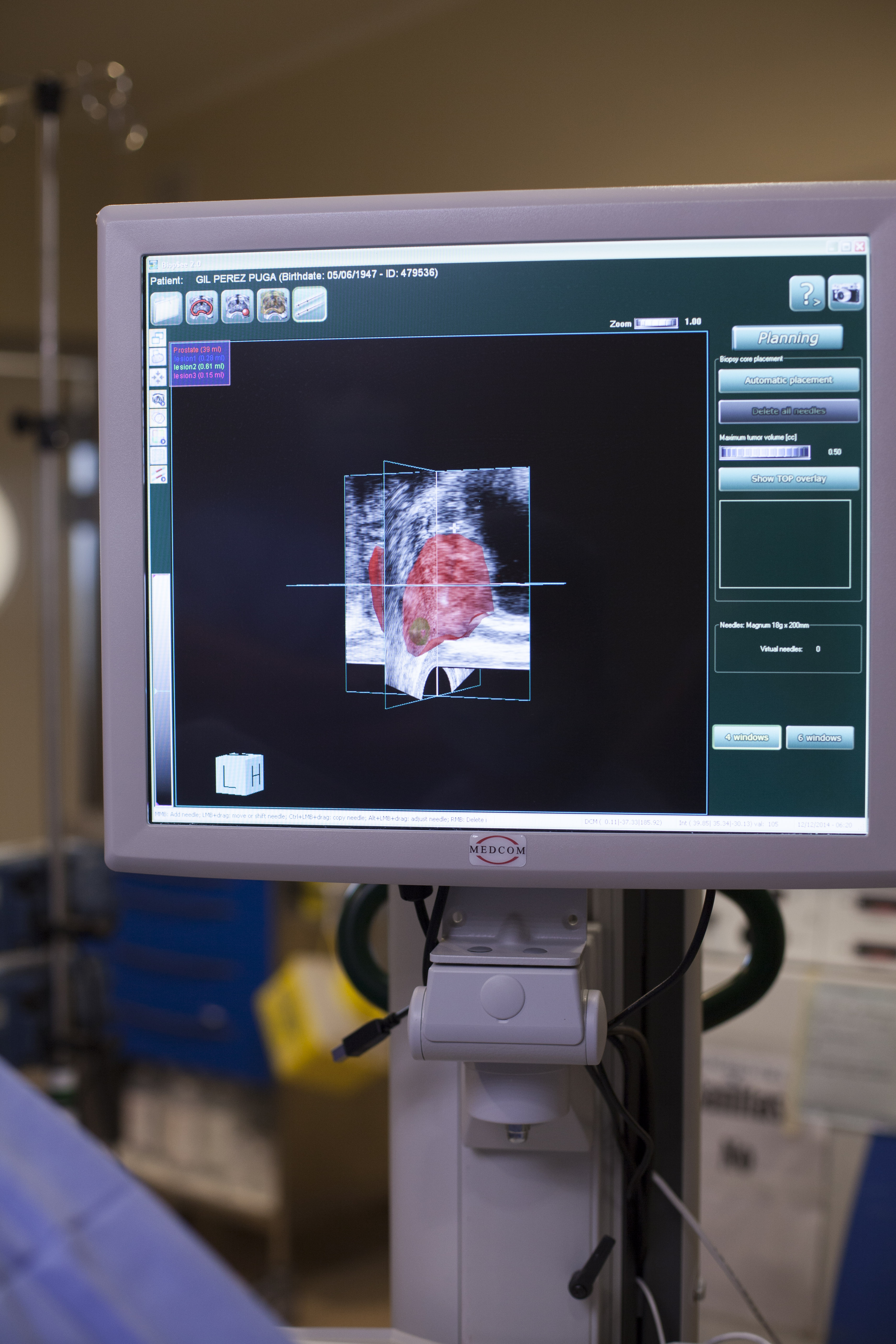 Tratamiento con láser para el cáncer de próstata en Australia
