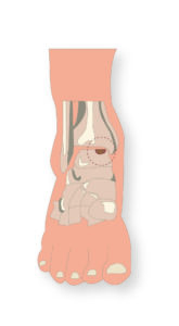 lesion cartilago tobillo