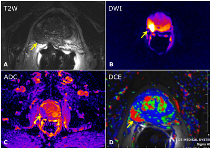 Cancer de prostata resonancia magnetica