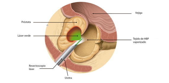 tumor benigno prostata tratamiento)