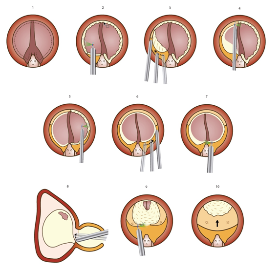 tumor benigno prostata operacion