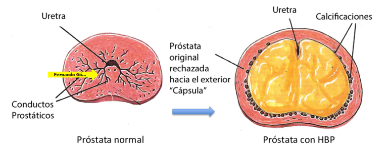 prostata adenom