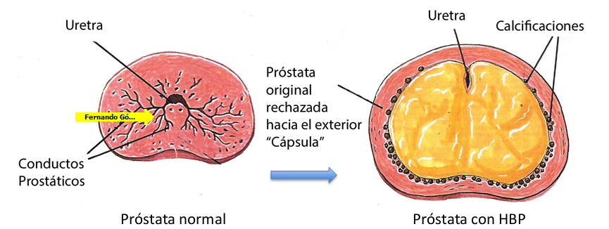 tumor benigno prostata operacion