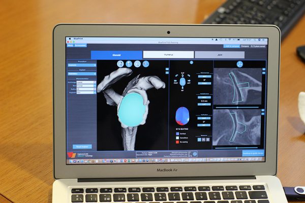 Protesis Hombro en Cirugia Virtual