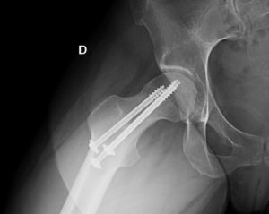 Fractura Estres Cadera Cirugia