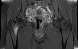 Fractura Estres Cadera Resonancia Magnetica