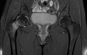 Fractura Estres Cadera Resonancia