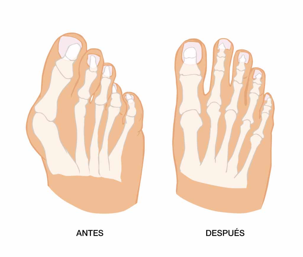 Hallux Valgus Antes Despues