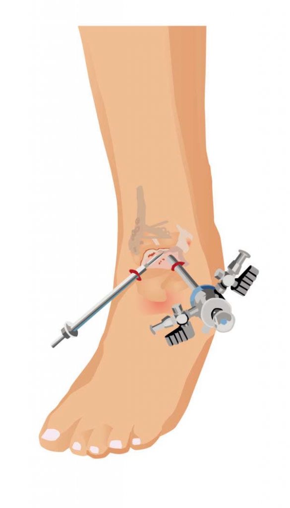 Intervencion Artroscopica Tobillo