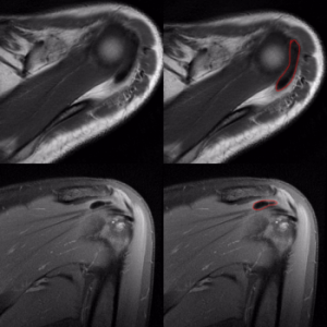 Radiografia Tendinitis Calcificante Hombro