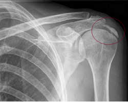 Tendinitis Calcificante Articulacion Hombro