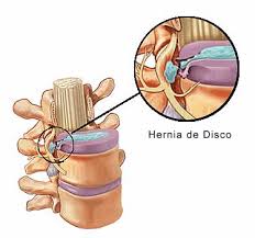 Anatomia Hernia Discal