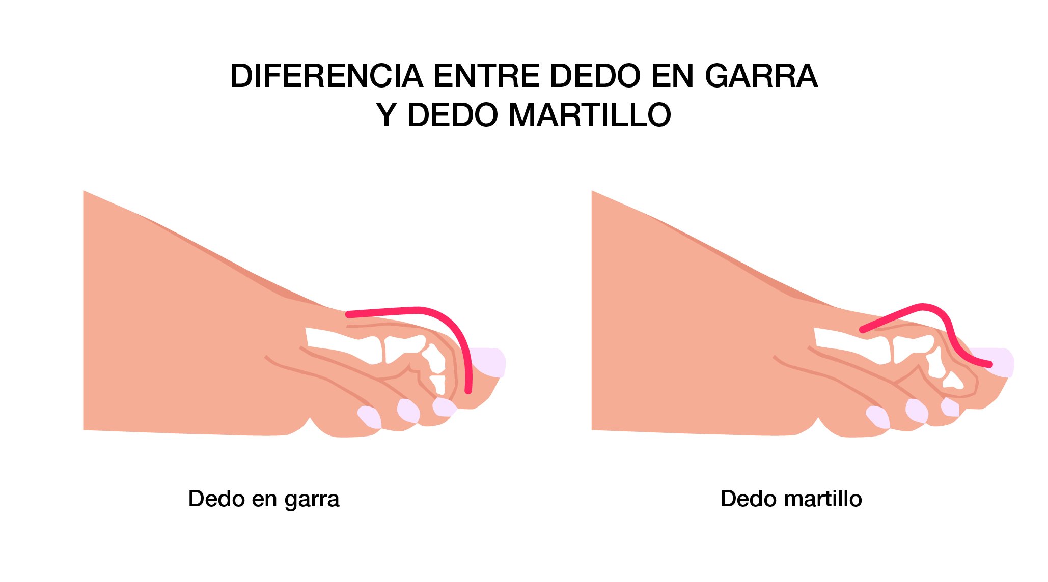 Diferencia Dedo Garra y Martillo