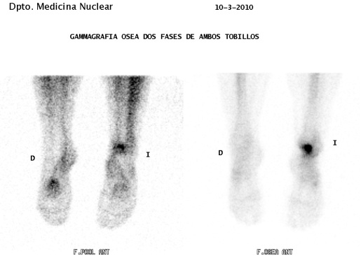 Gammagrafia Lesion Cartilago Tobillo