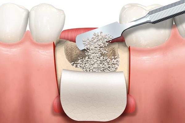 Regeneracion Osea en Implantes Dentales