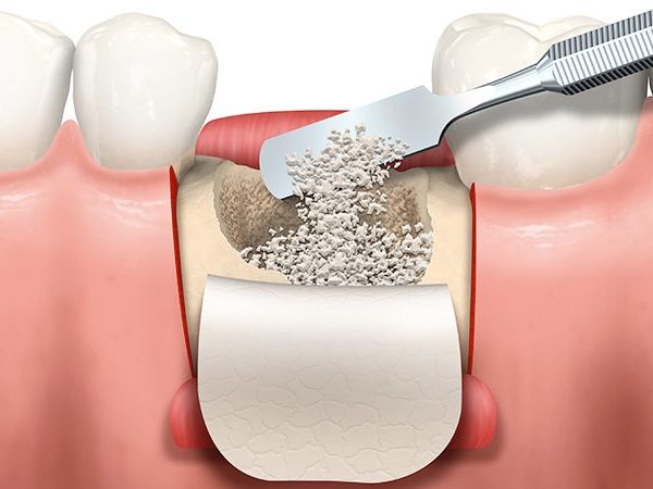 Regeneracion Osea en Implantes Dentales