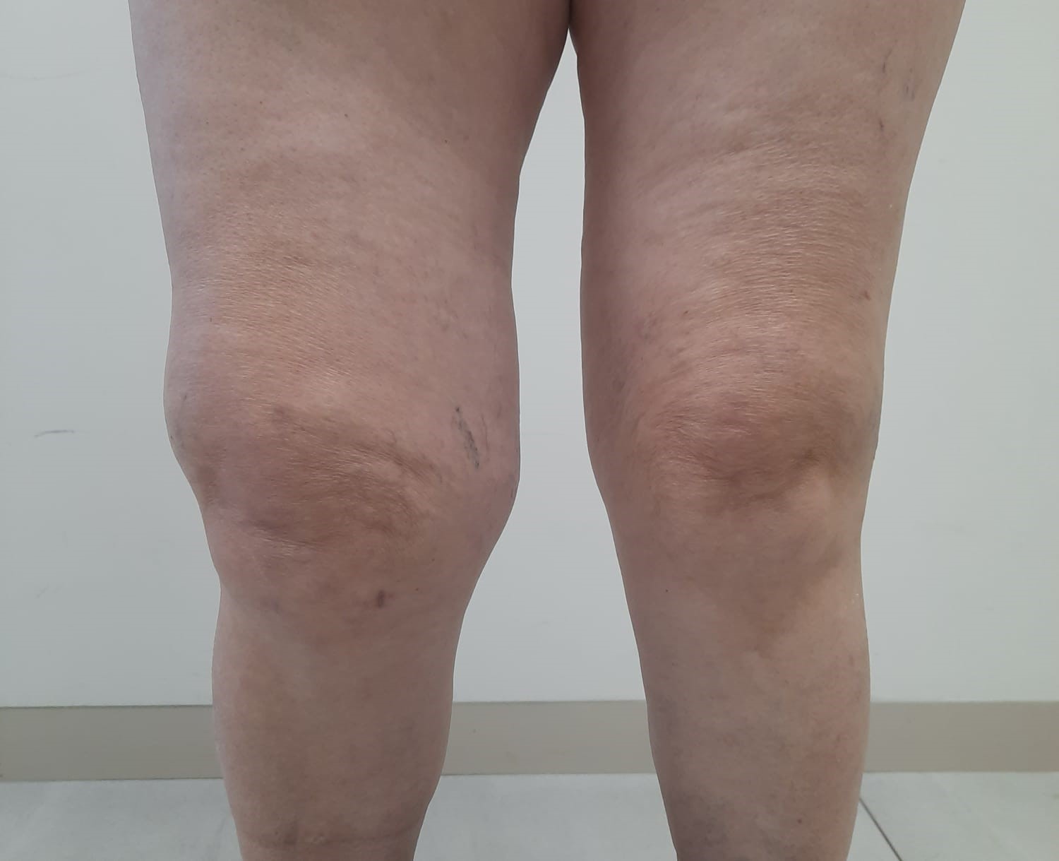 Líquido en la rodilla: Causas, Síntomas y Tratamiento