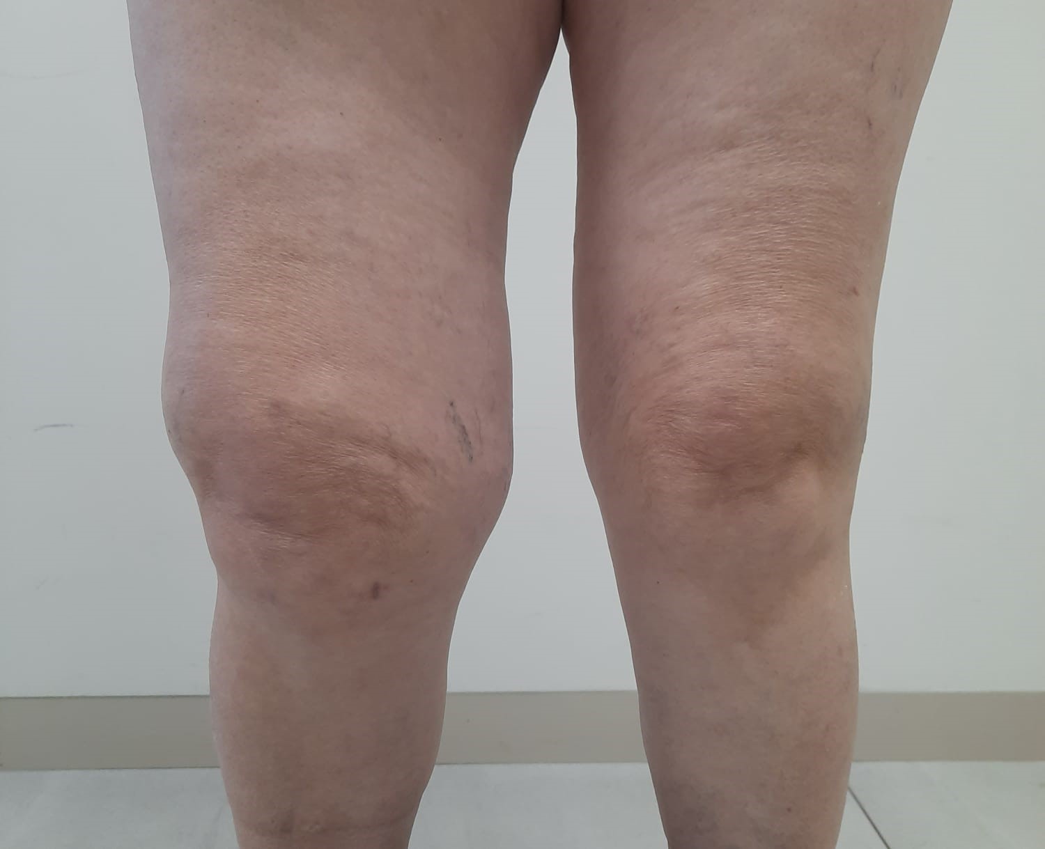 Artrosis o gonartrosis de rodilla. Síntomas y tratamiento