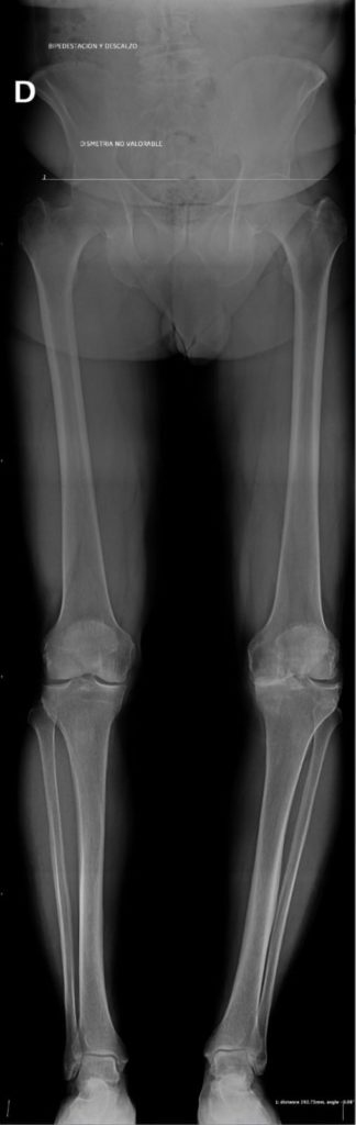 Artrosis de rodilla (Gonartrosis):Como aliviar el dolor de rodillas