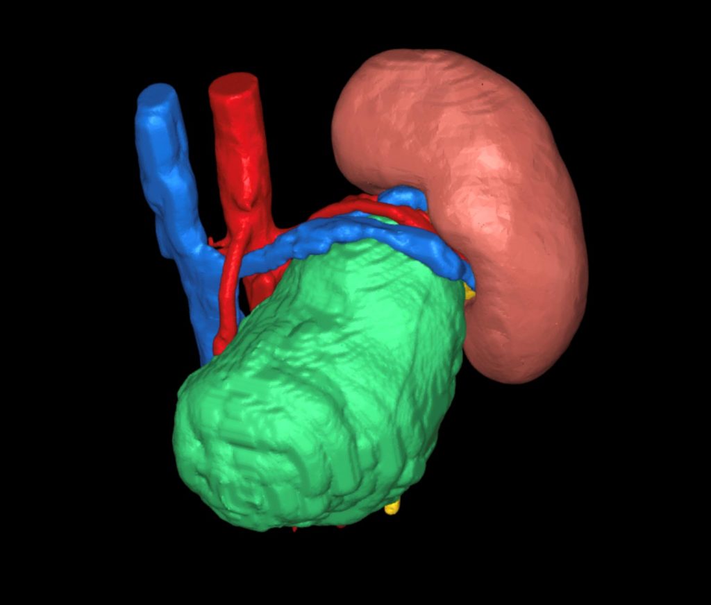 cemtro cirugia cancer testiculo avanzada