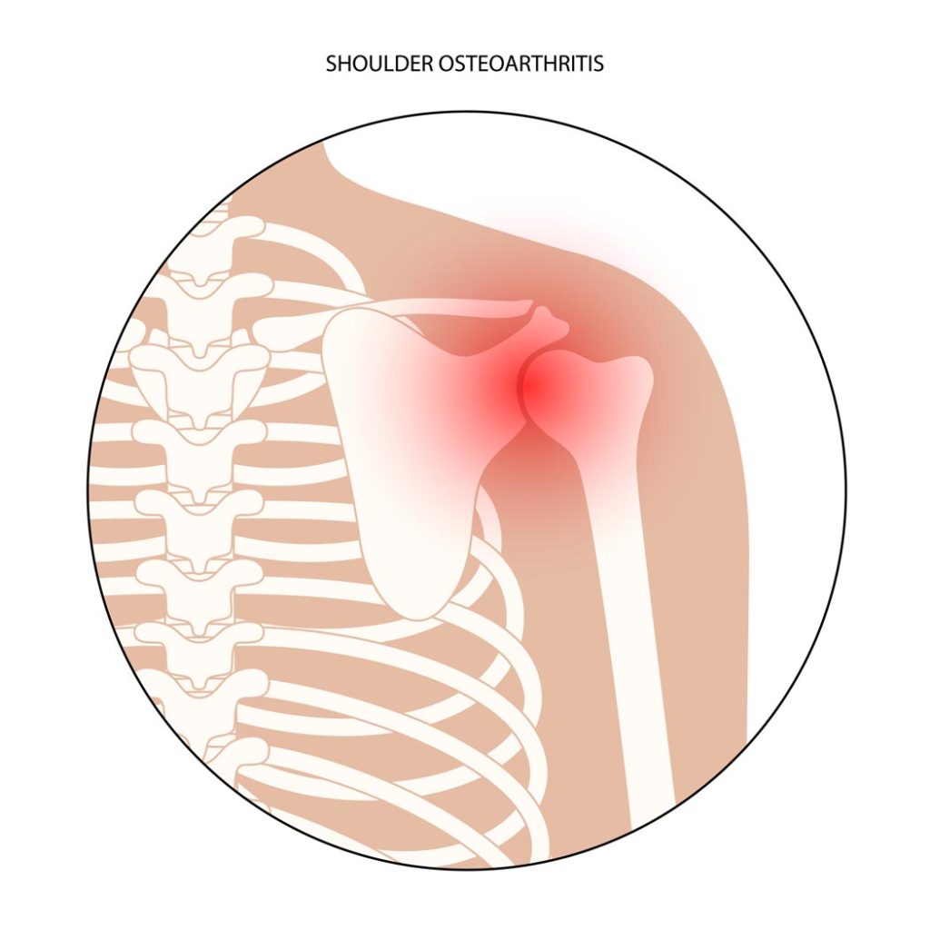 diagnostico dolor hombro causas tratamiento