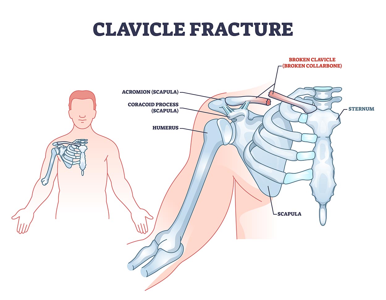 cemtro causas fracturas clavicula