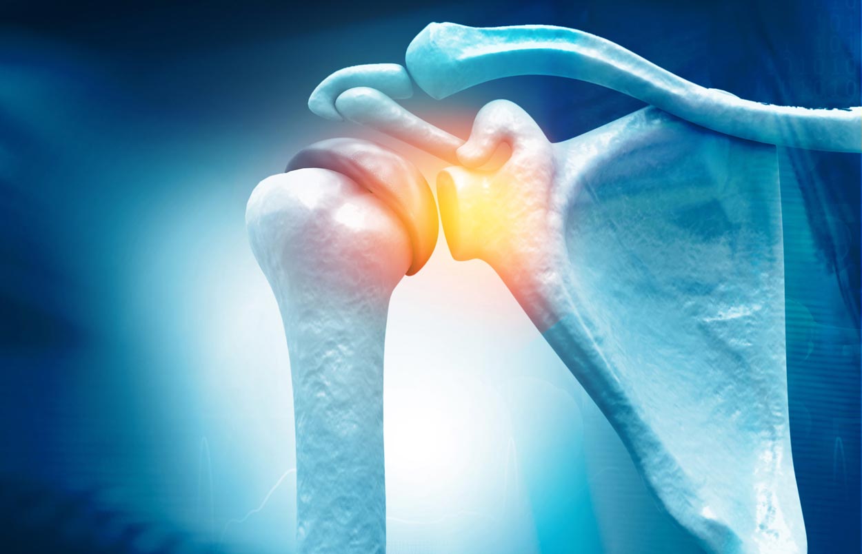 fracturas clavicula causas tratamiento