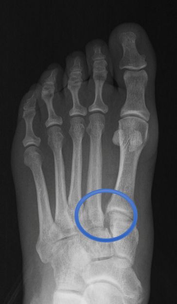 Lesión de lisfranc radiografia