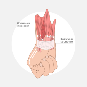 Sindrome de entrecruzamiento clinica cemtro