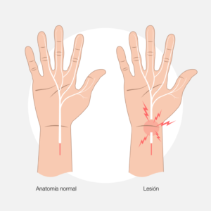 Tendinopatia del extensor cubital del carpo