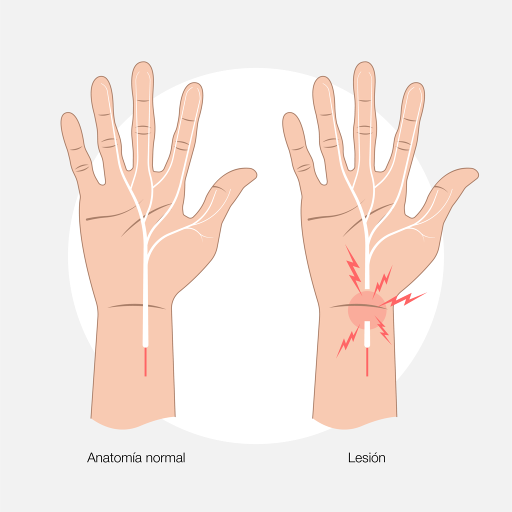Tendinitis De Muñeca Síntomas Tipos Y Tratamiento 