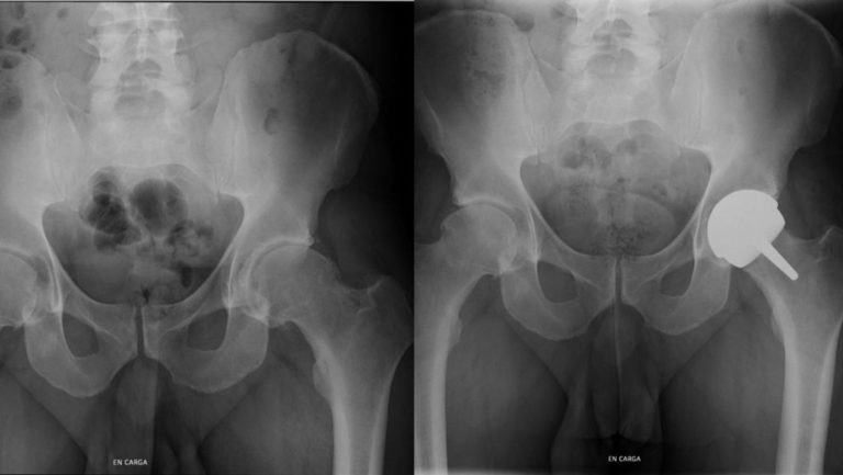 radiografia-protesis-cadera-adulto