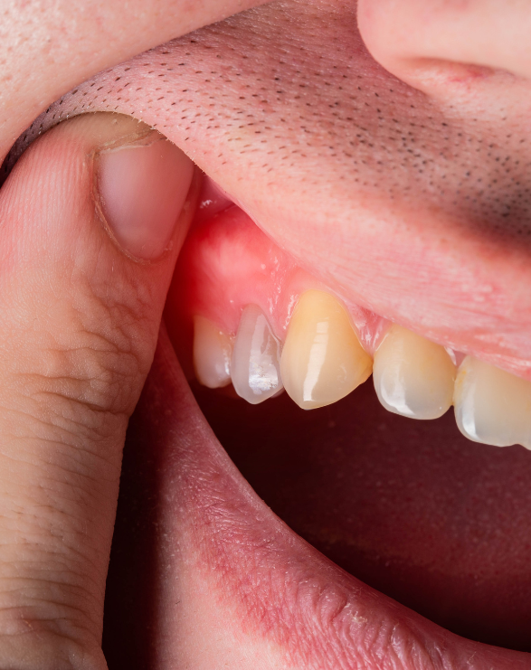 PERIODONCIA